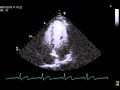 Contrast enhanced ultrasound of the Left Ventricle